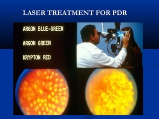LASER TREATMENT FOR PDR
 