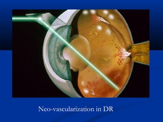 Neo-vascularization in DR
 