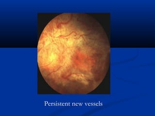 Persistent new vessels
 