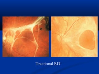 Tractional RD
 