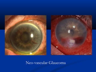 Neo-vascular Glaucoma
 
