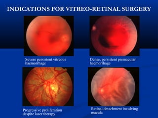 INDICATIONS FOR VITREO-RETINAL SURGERY
Retinal detachment involving
macula
Severe persistent vitreous
haemorrhage
Dense, persistent premacular
haemorrhage
Progressive proliferation
despite laser therapy
 