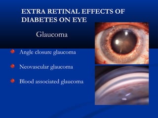 Glaucoma
Angle closure glaucoma
Neovascular glaucoma
Blood associated glaucoma
EXTRA RETINAL EFFECTS OF
DIABETES ON EYE
 