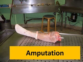 Amputation
 
