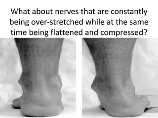 What about nerves that are constantly
being over-stretched while at the same
time being flattened and compressed?
 