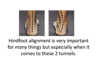 Hindfoot alignment is very important
for many things but especially when it
      comes to these 2 tunnels.
 