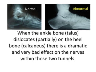 Normal                Abnormal




    When the ankle bone (talus)
  dislocates (partially) on the heel
bone (calcaneus) there is a dramatic
 and very bad effect on the nerves
      within those two tunnels.
 