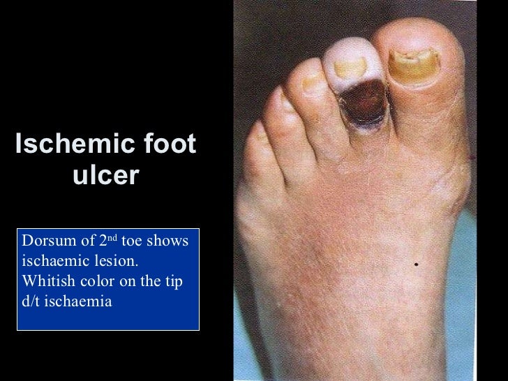 Diabetic related infection and management