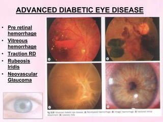 Diabetic retinopathy | PPTX