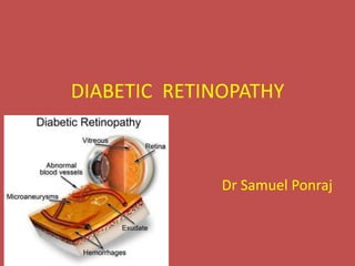 DIABETIC RETINOPATHY
Dr Samuel Ponraj
 