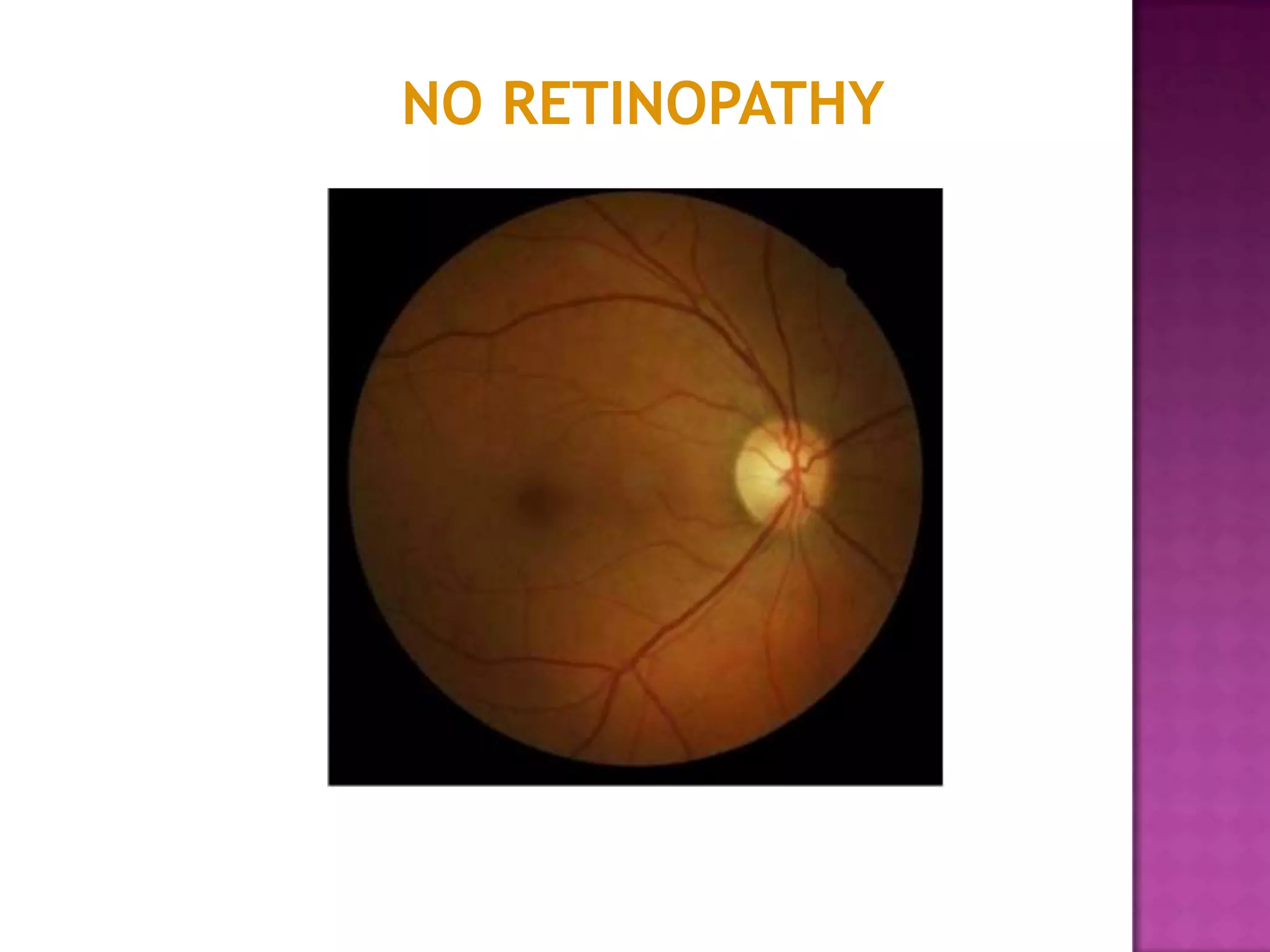 NO RETINOPATHY

 