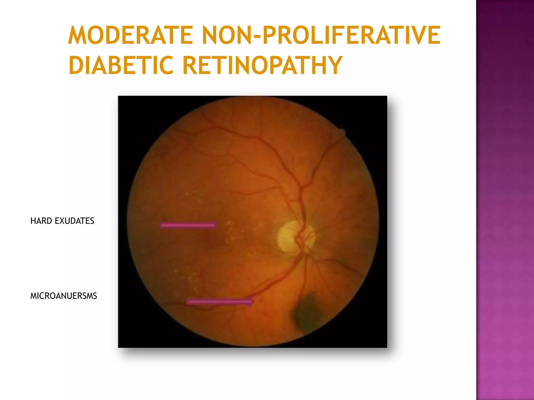 MODERATE NON-PROLIFERATIVE
DIABETIC RETINOPATHY

HARD EXUDATES

MICROANUERSMS

 
