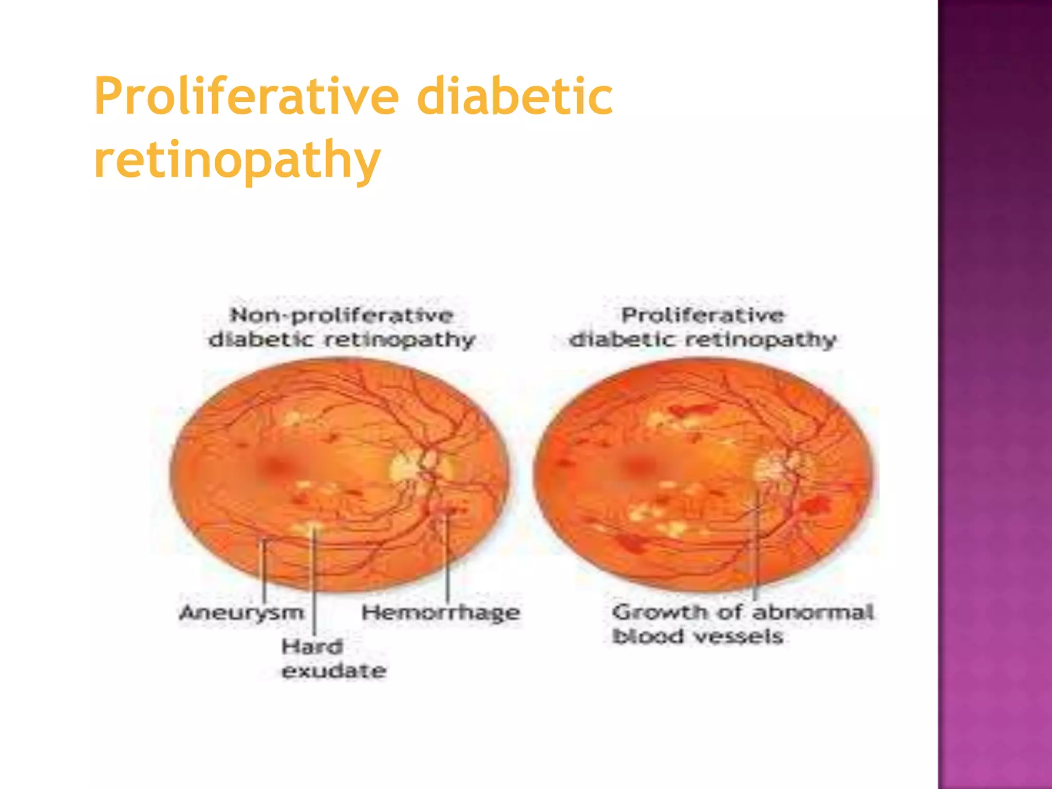 Proliferative diabetic
retinopathy

 