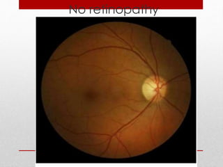No retinopathy 
 