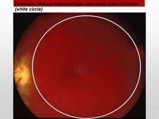 Extensive vitreous haemorrhage obscuring most of fundus 
(white circle) 
 