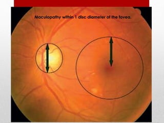 Maculopathy within 1 disc diameter of the fovea. 
 