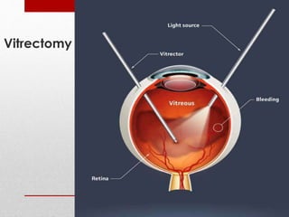 Vitrectomy 
 
