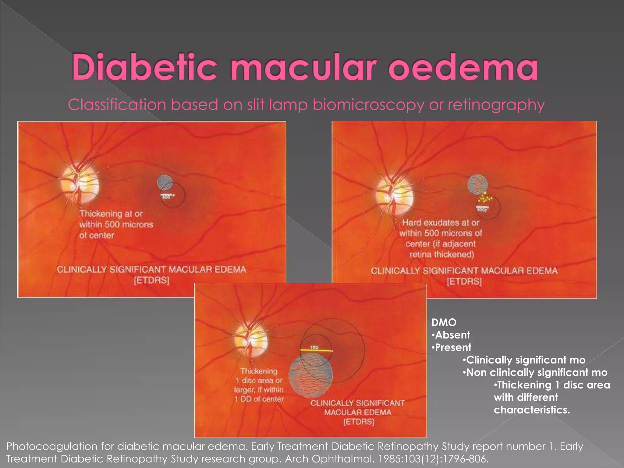 Diabetic retinopathy | PPTX