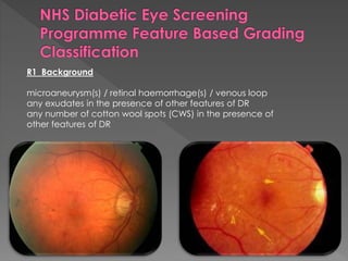 R1 Background 
microaneurysm(s) / retinal haemorrhage(s) / venous loop 
any exudates in the presence of other features of DR 
any number of cotton wool spots (CWS) in the presence of 
other features of DR 
 