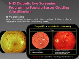 R2 Pre-proliferative 
venous beading / venous reduplication / multiple blot haemorrhages 
intraretinal microvascular abnormality (IRMA) 
 