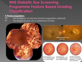 P Photocoagulation 
P0 No evidence of previous photocoagulation (default) 
P1 focal/grid to macula or peripheral scatter 
 