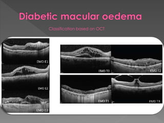 Classification based on OCT 
 