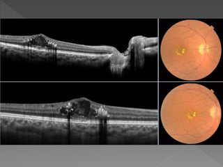 Diabetic retinopathy