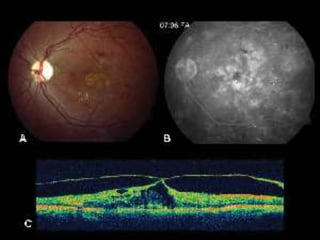 Diabetic retinopathy