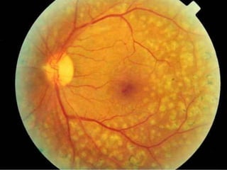 Diabetic retinopathy