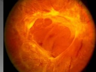 Diabetic retinopathy