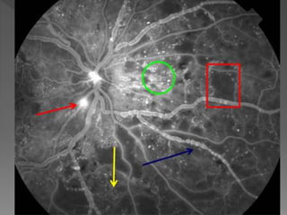 Diabetic retinopathy