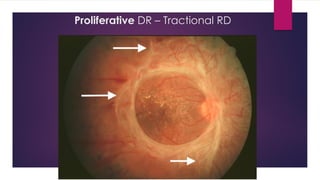 Diabetic retinopathy | PDF