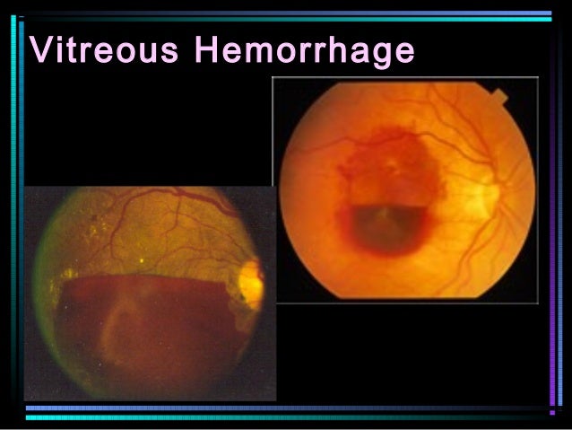 detached retina symptoms blood detached retina symptoms blood