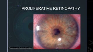 Diabetic Retinopathy | PPTX