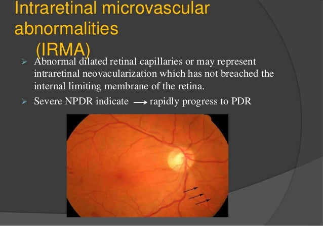 Diabetic Retinopathy
