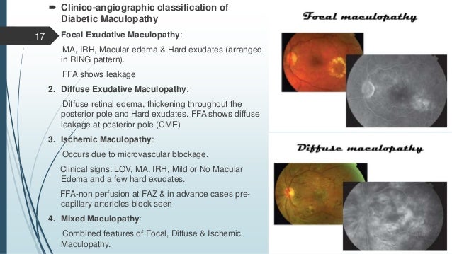 Diabetic Retinopathy diabetic-retinopathy