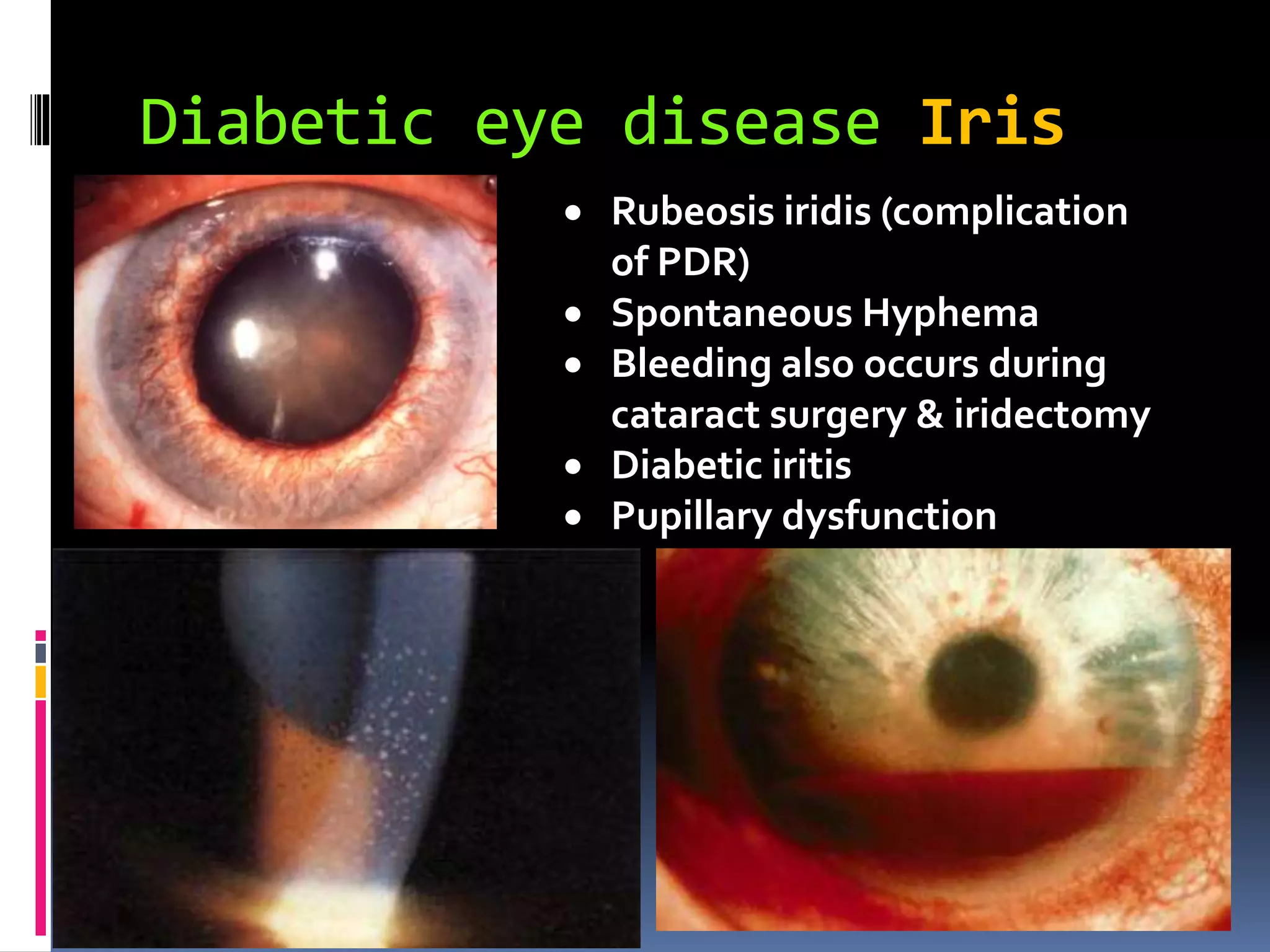 Diabetic retinopathy | PPT