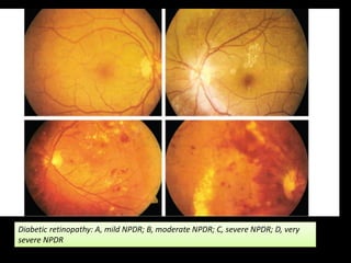 Diabetic retinopathy: A, mild NPDR; B, moderate NPDR; C, severe NPDR; D, very
severe NPDR
 