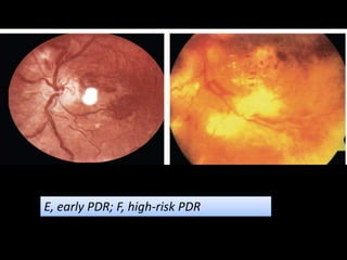 E, early PDR; F, high-risk PDR
 