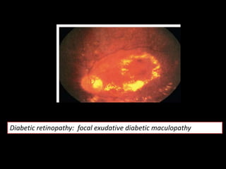 Diabetic retinopathy: focal exudative diabetic maculopathy
 