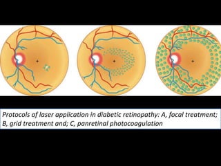 Protocols of laser application in diabetic retinopathy: A, focal treatment;
B, grid treatment and; C, panretinal photocoagulation
 