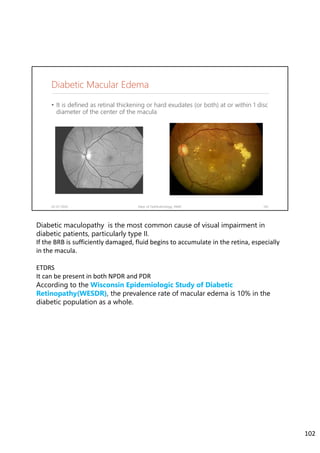 Diabetic Macular Edema
• It is defined as retinal thickening or hard exudates (or both) at or within 1 disc
diameter of the center of the macula
02-07-2020 Dept. of Ophthalmology, JNMC 102
Diabetic maculopathy is the most common cause of visual impairment in
diabetic patients, particularly type II.
If the BRB is sufficiently damaged, fluid begins to accumulate in the retina, especially 
in the macula.
ETDRS
It can be present in both NPDR and PDR
According to the Wisconsin Epidemiologic Study of Diabetic
Retinopathy(WESDR), the prevalence rate of macular edema is 10% in the
diabetic population as a whole.
102
 