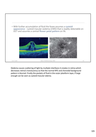 • With further accumulation of fluid the fovea assumes a cystoid
appearance - cystoid macular oedema (CMO) that is readily detectable on
OCT and assumes a central flower petal pattern on FA.
02-07-2020 Dept. of Ophthalmology, JNMC 105
Oedema causes scattering of light by multiple interfaces it creates in retina which 
decreases retina’s translucency so that the normal RPE and choroidal background 
pattern is blurred. Finally the pockets of fluid in the outer plexiform layer, if large 
enough can be seen as cystoid macular edema.
105
 