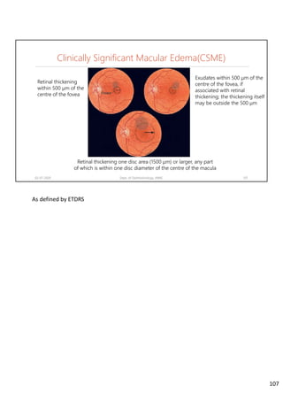02-07-2020 Dept. of Ophthalmology, JNMC 107
Retinal thickening
within 500 μm of the
centre of the fovea
Exudates within 500 μm of the
centre of the fovea, if
associated with retinal
thickening; the thickening itself
may be outside the 500 μm
Retinal thickening one disc area (1500 μm) or larger, any part
of which is within one disc diameter of the centre of the macula
Clinically Significant Macular Edema(CSME)
As defined by ETDRS 
107
 