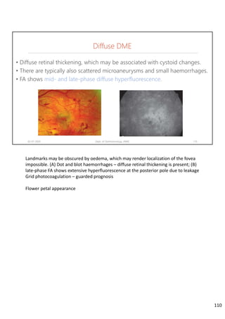 Diffuse DME
• Diffuse retinal thickening, which may be associated with cystoid changes.
• There are typically also scattered microaneurysms and small haemorrhages.
• FA shows mid- and late-phase diffuse hyperfluorescence.
02-07-2020 Dept. of Ophthalmology, JNMC 110
Landmarks may be obscured by oedema, which may render localization of the fovea 
impossible. (A) Dot and blot haemorrhages – diffuse retinal thickening is present; (B) 
late‐phase FA shows extensive hyperfluorescence at the posterior pole due to leakage
Grid photocoagulation – guarded prognosis
Flower petal appearance
110
 