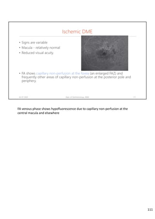 Ischemic DME
• Signs are variable
• Macula - relatively normal
• Reduced visual acuity.
• FA shows capillary non-perfusion at the fovea (an enlarged FAZ) and
frequently other areas of capillary non-perfusion at the posterior pole and
periphery.
02-07-2020 Dept. of Ophthalmology, JNMC 111
FA venous phase shows hypofluorescence due to capillary non‐perfusion at the 
central macula and elsewhere
111
 
