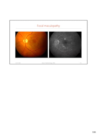 Focal maculopathy
02-07-2020 Dept. of Ophthalmology, JNMC 116
116
 