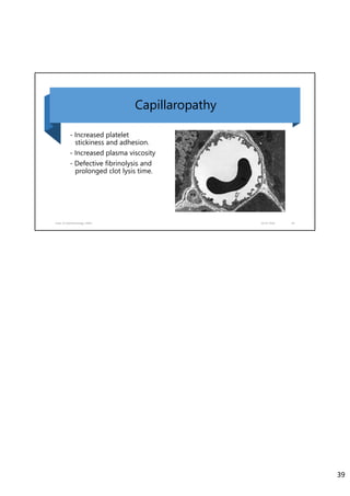 - Increased platelet
stickiness and adhesion.
- Increased plasma viscosity
- Defective fibrinolysis and
prolonged clot lysis time.
Dept. of Ophthalmology, JNMC 02‐07‐2020 39
Capillaropathy
39
 