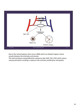 02‐07‐2020 Dept. of Ophthalmology, JNMC 41
Due to the retinal hypoxia, there occurs IRMA which are dilated irregular retinal 
vessels between the arterioles and venules. 
The retina produces vasoproliferative substances like VEGF, TGF, CTGF which induce 
neovascularisation resulting in rubeosis iridis and later proliferative retinopathy.
41
 