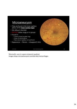 Microaneurysm
• They are found in the Inner capillary
plexus of the inner nuclear layer
• 10- 125 μ in diameter
• Red dots either singly or in groups
• Found in:
• Center of hard exudate rings
• Areas of retinal edema
• Near area of capillary non-perfusion
• Appearance → fibrosis → disappear(3–4m).
56
Maximally seen in supero-temporal quadrant
Image shows microaneurysms and dot‐blot hemorrhages
56
 